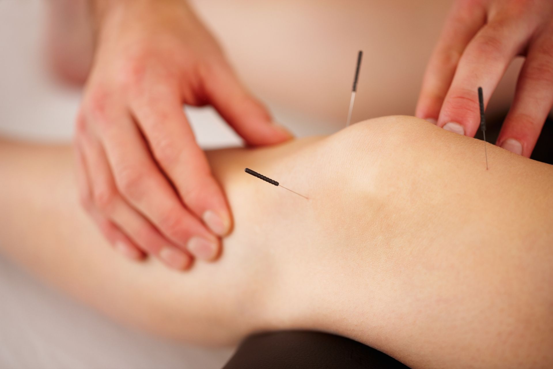 Electro Acupuncture — Glenview, IL — Healing Spring Acupuncture Center