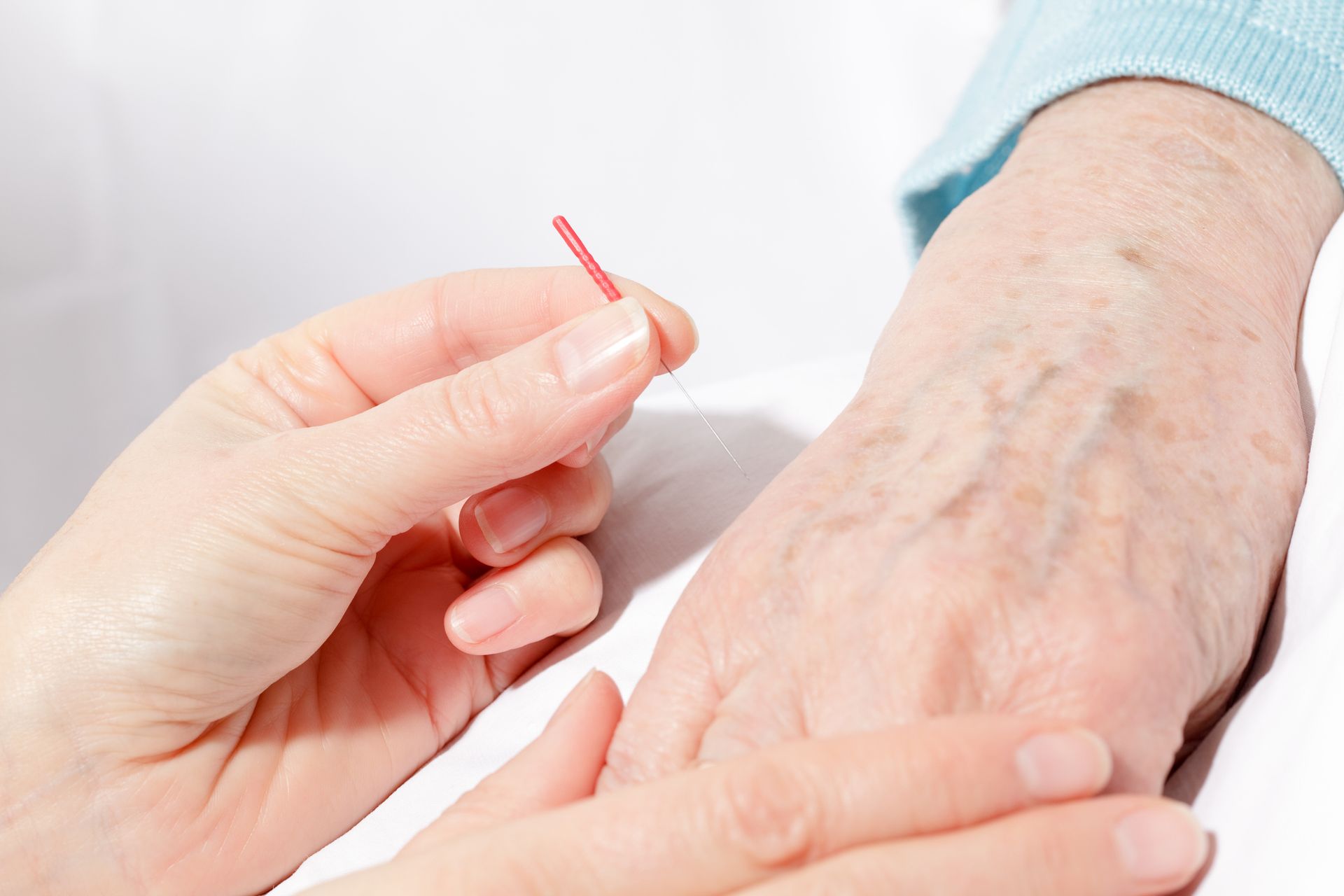 Woman Is Giving An Acupuncture — Glenview, IL — Healing Spring Acupuncture Center