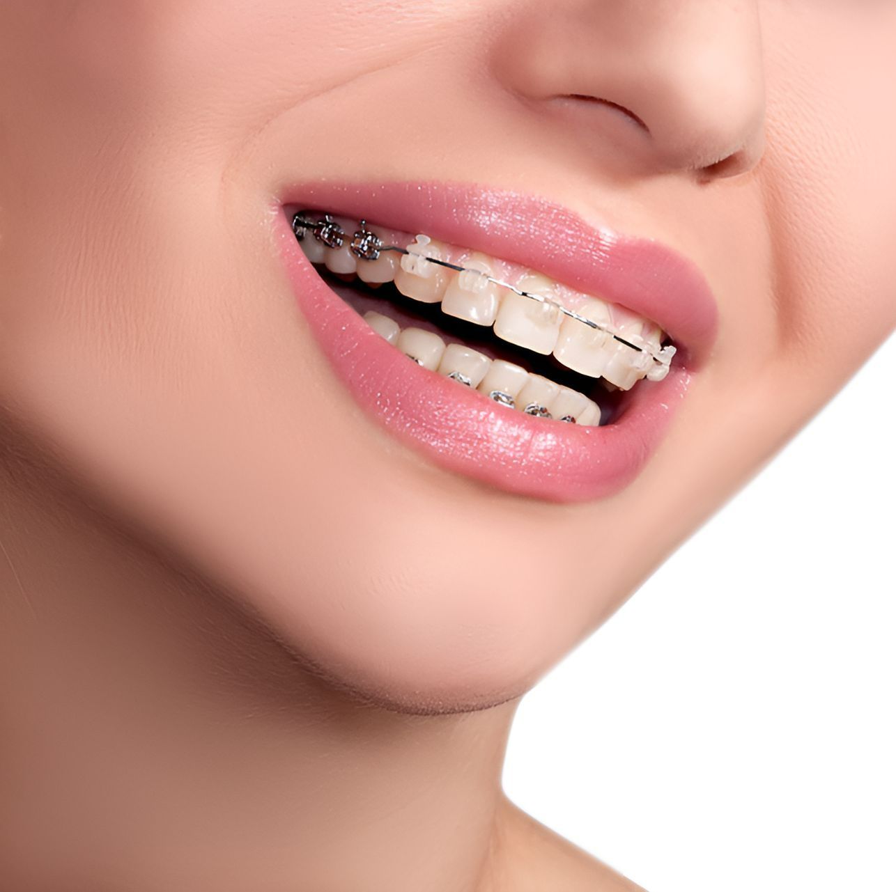A Close Up of a Woman 's Mouth With Braces on Her Teeth  — Graham Johnson Dental Surgery In Beresfield, NSW