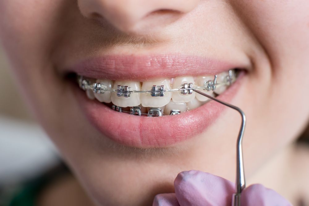 A Woman With Braces is Getting Her Teeth Examined by a Dentist — Graham Johnson Dental Surgery In Beresfield, NSW