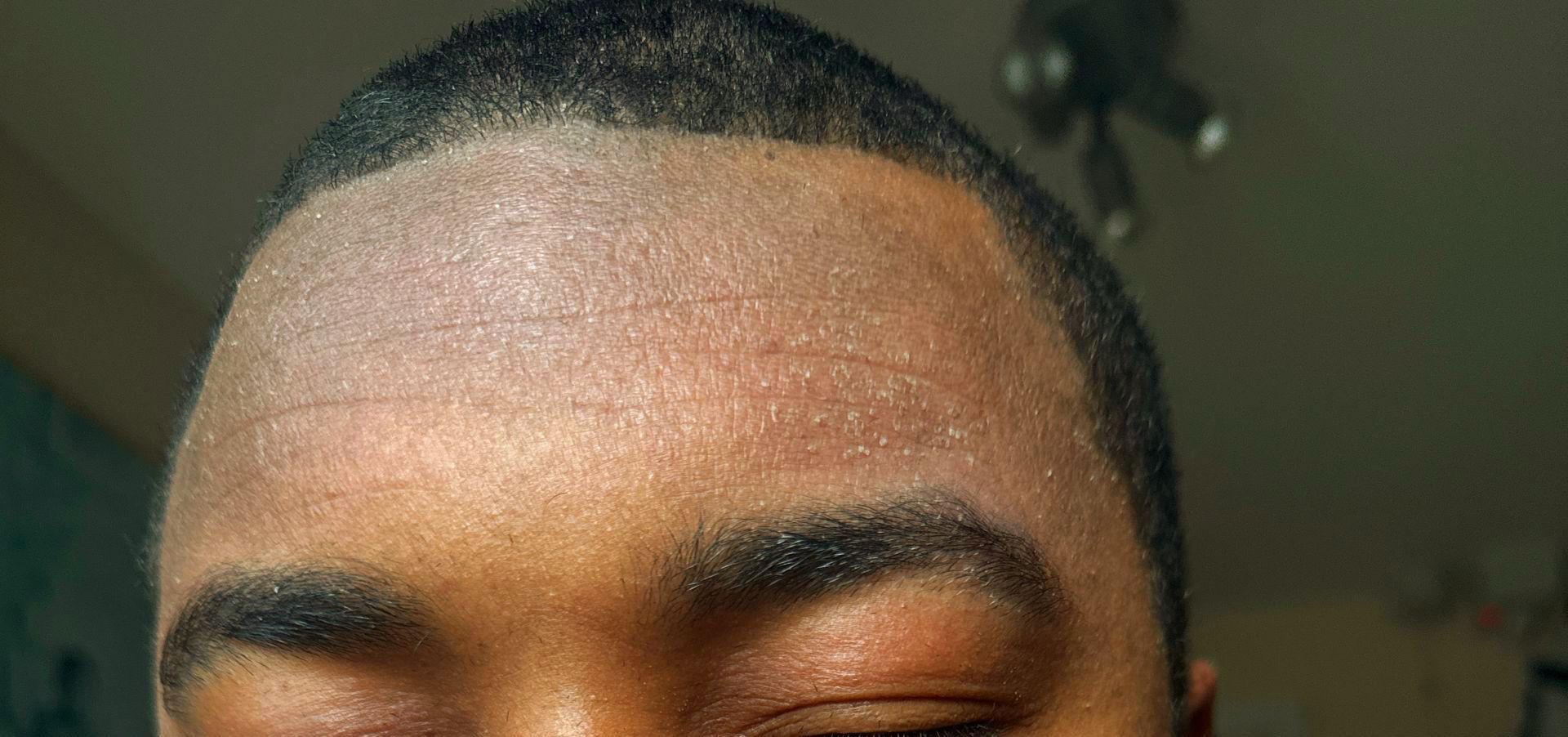 dry skin on forehead