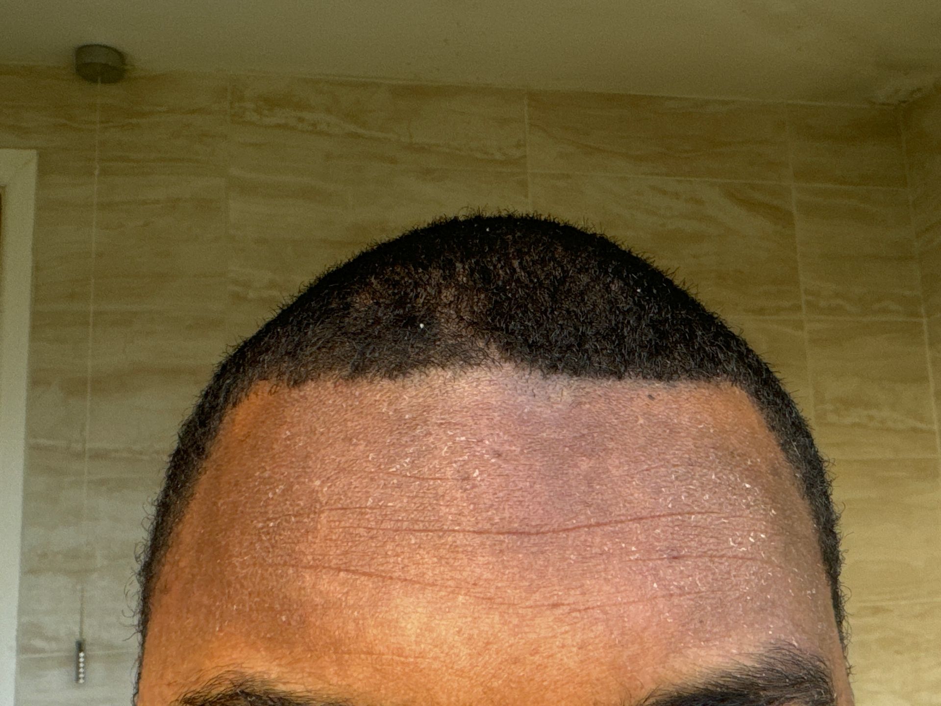 dry skin on forehead