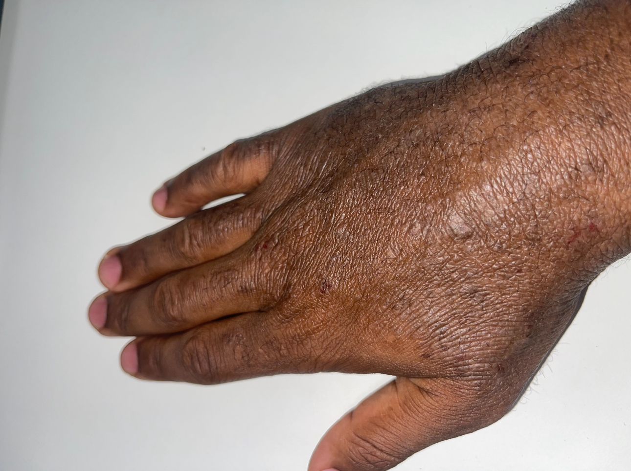 dry eczema on hand