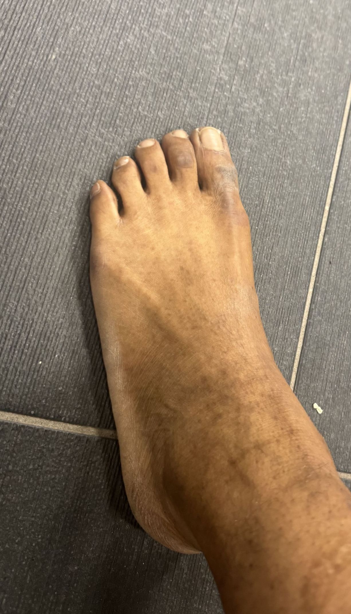 dry eczema skin on foot