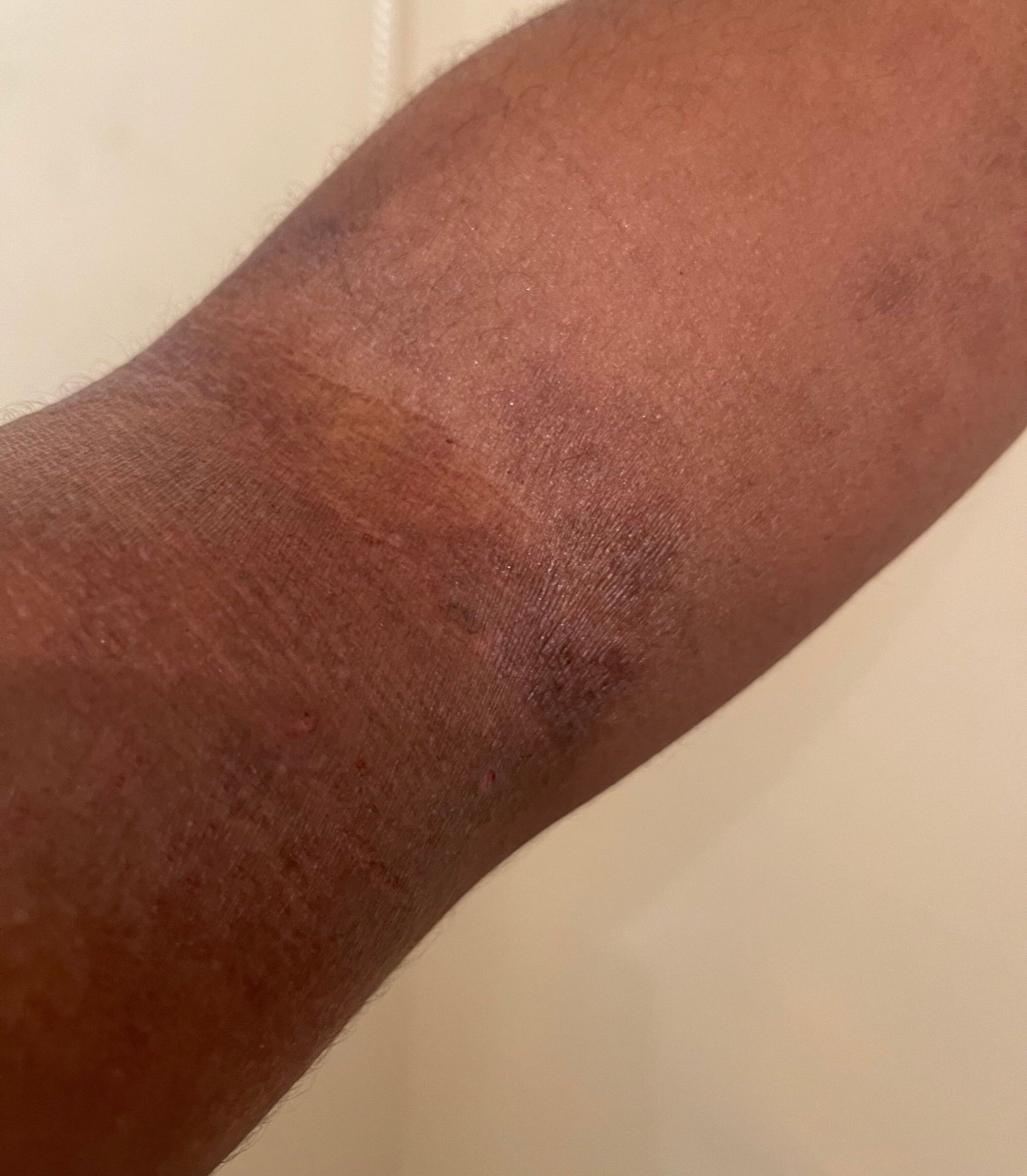 dry eczema on arm