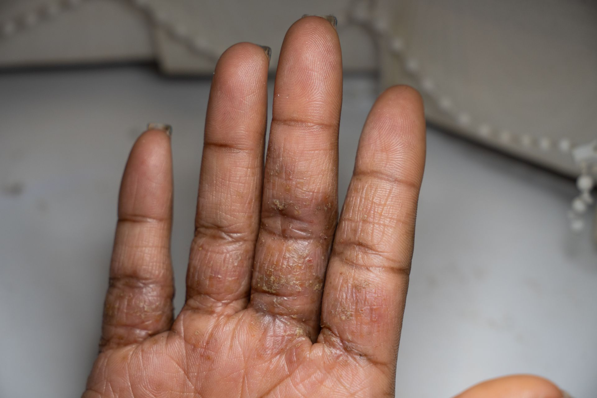 Eczema on hand