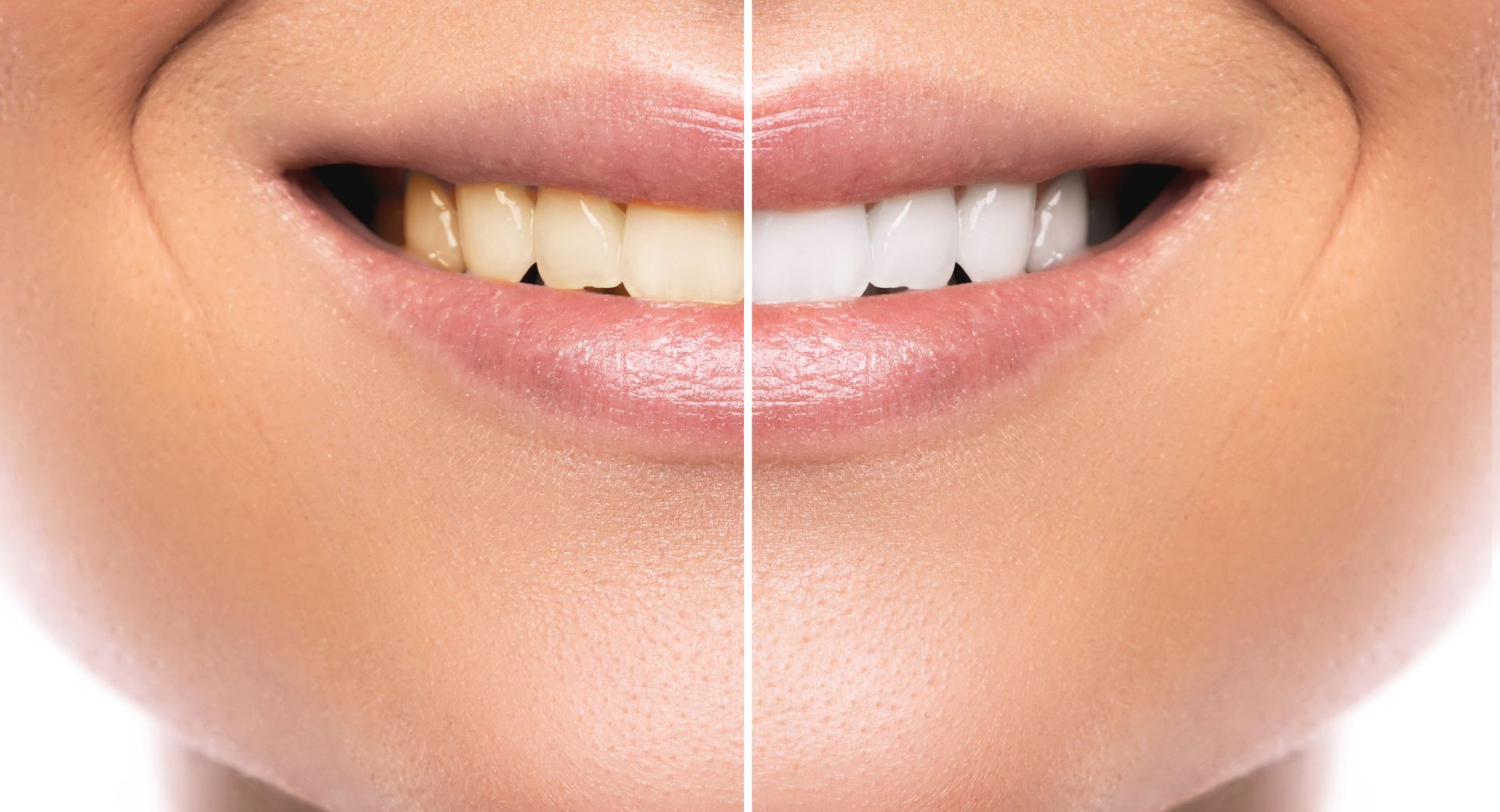 Close-up of a smile showing a side-by-side comparison of teeth before and after whitening.