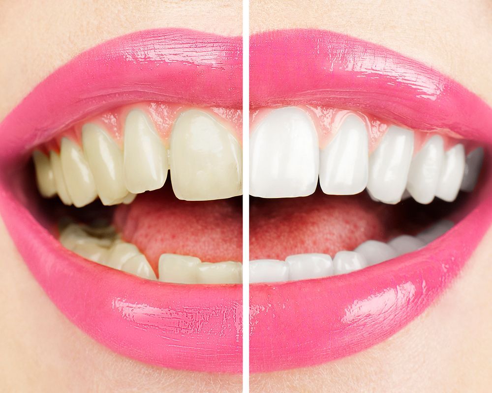 Woman with white teeth after professional teeth whitening