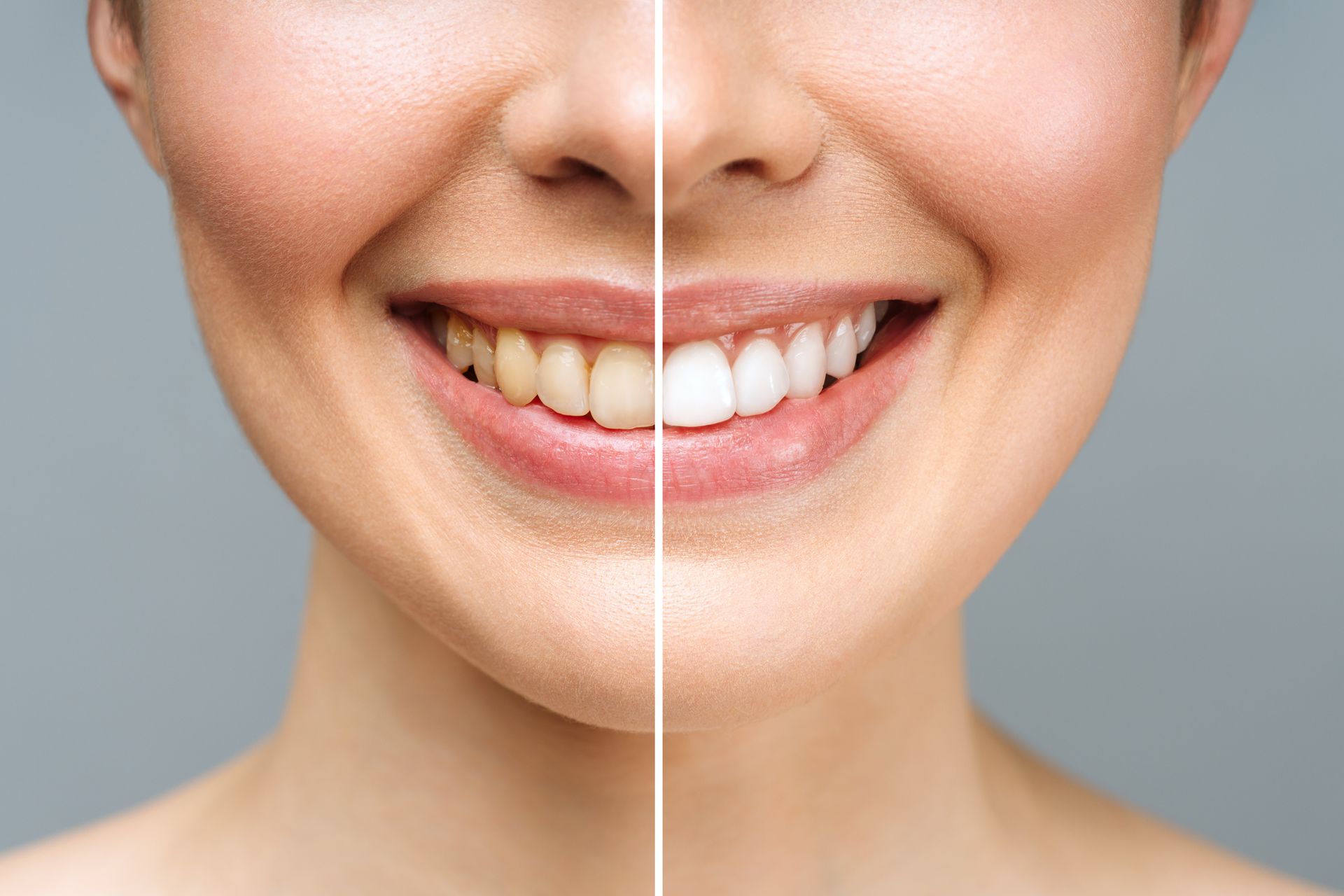 Woman's before/after smiling at Carolyn Bronke DDS clinic, over white background, showcasing oral ca