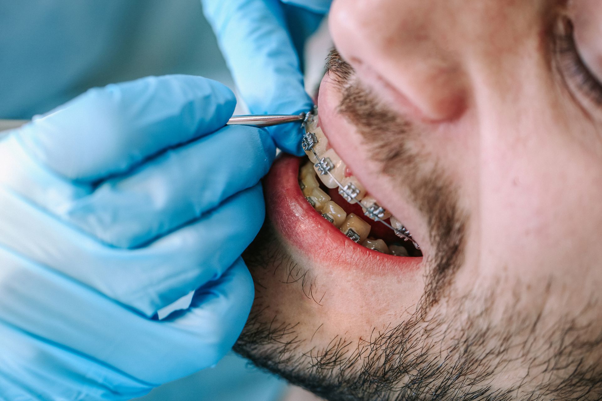 A man with braces is getting his teeth examined by a dentist.
