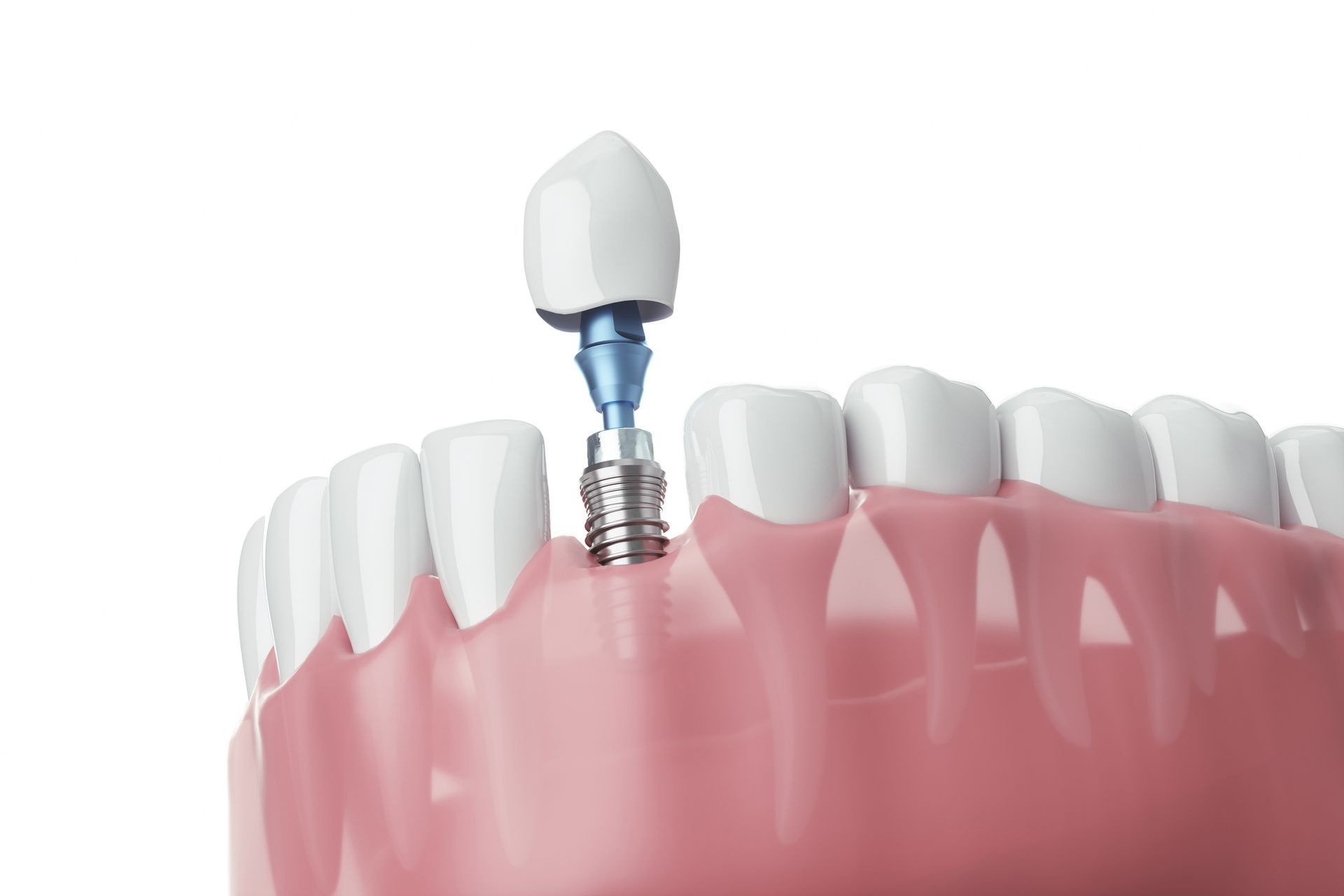 A 3d rendering of a dental implant in a tooth.