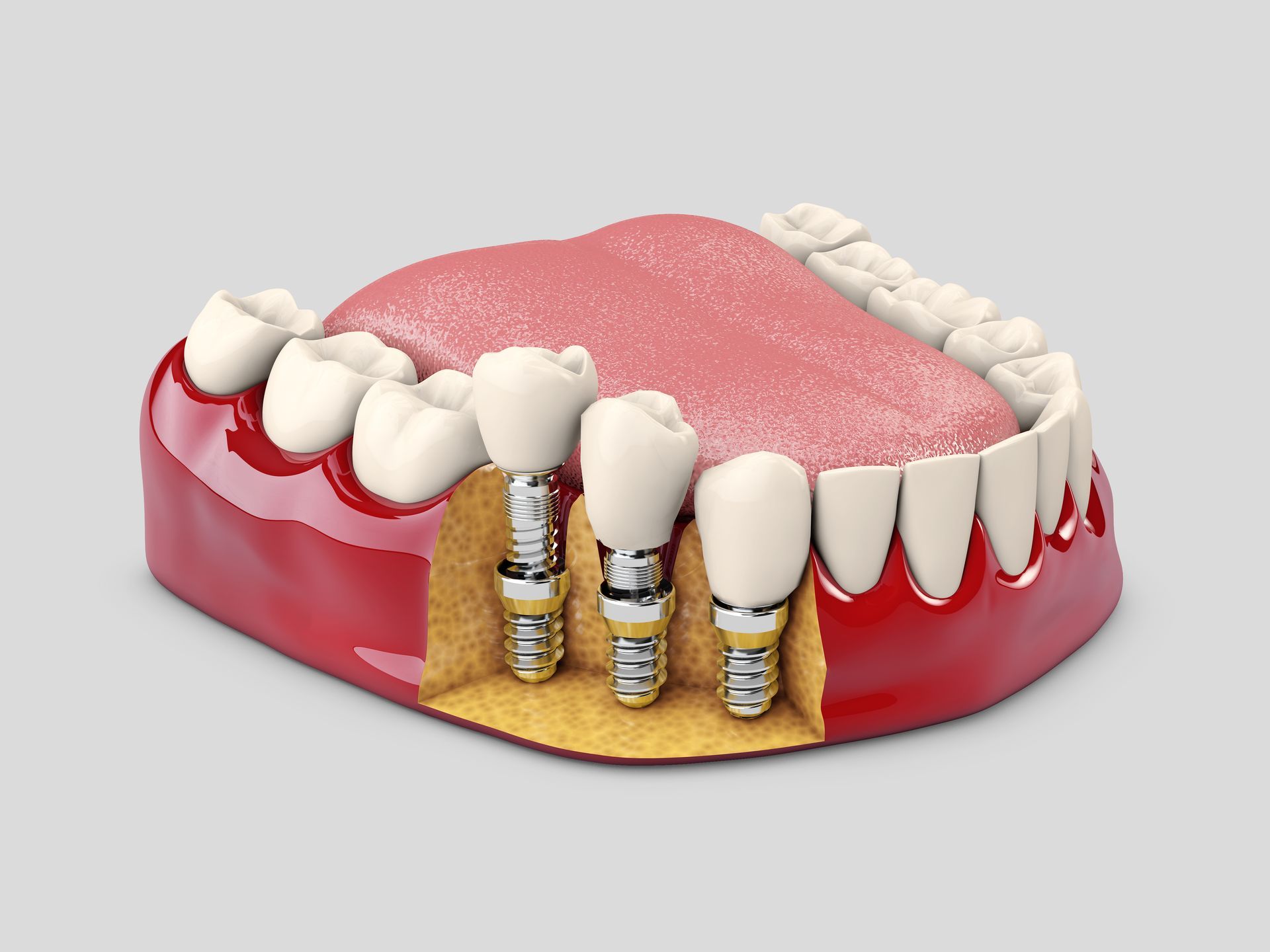 A Model of a Mouth With Dental Implants in It — Dental Prosthetics By Richard & Cindy In Oxenford, QLD