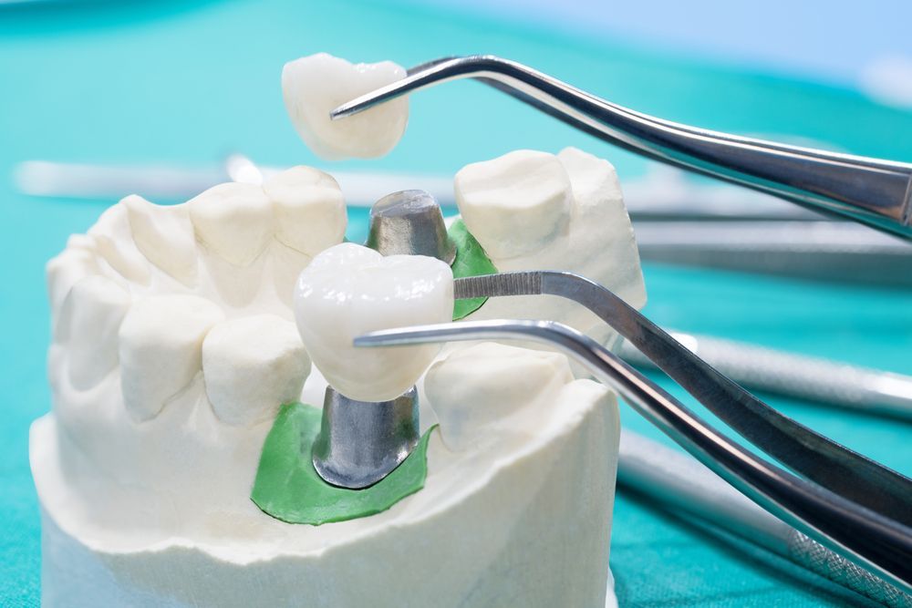 A Model of a Tooth With a Crown on It and Dental Instruments — Dental Prosthetics By Richard & Cindy In Oxenford, QLD