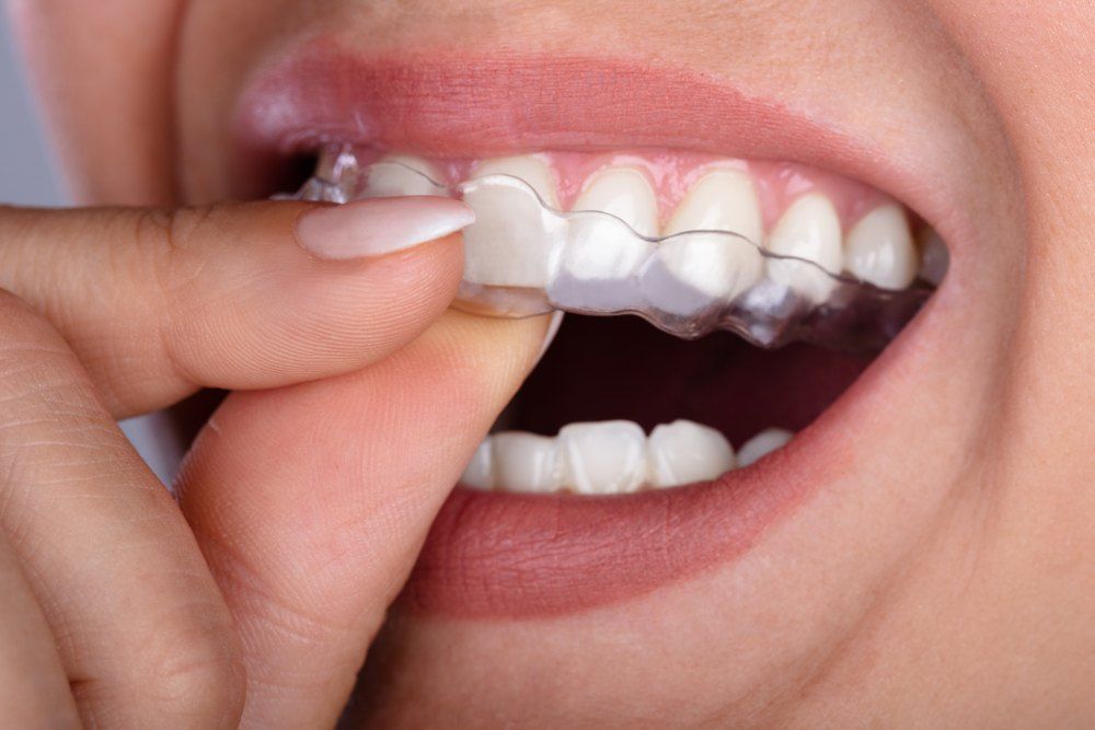 A Woman is Showing Her Teeth — Dental Prosthetics By Richard & Cindy in Labrador, QLD
