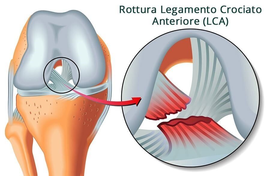 Il legamento crociato anteriore (LCA) è una struttura importante del ginocchio
