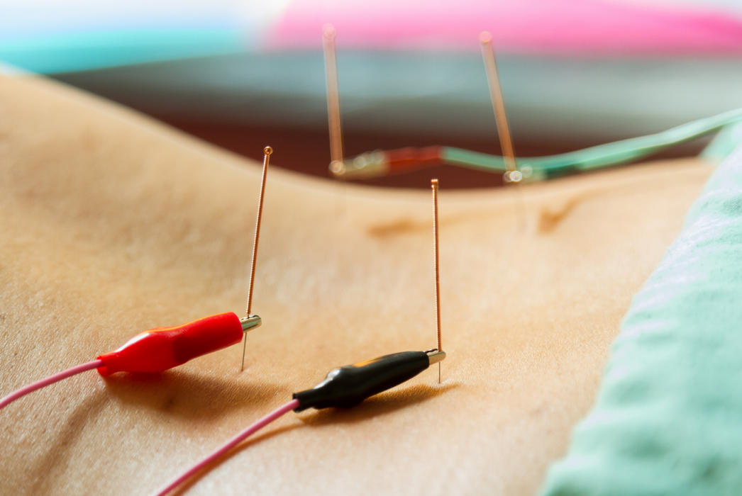 A person is getting acupuncture on their back.