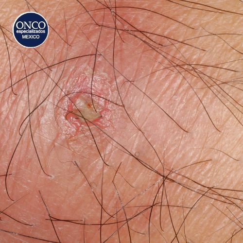 Absceso cutáneo relacionado con infecciones intraabdominales.