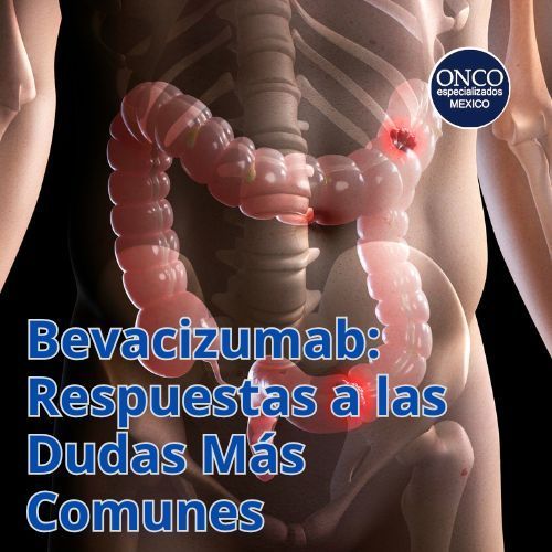 Colon humano resaltando zonas afectadas, relacionada con bevacizumab.