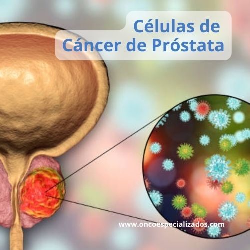 Ilustración mostrando células afectadas por cáncer de próstata.