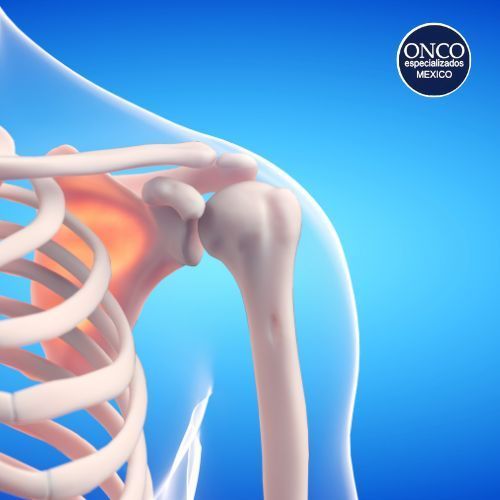 Osteoporosis Postmenopáusica