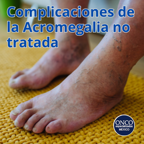Piernas hinchadas como complicación de la acromegalia.