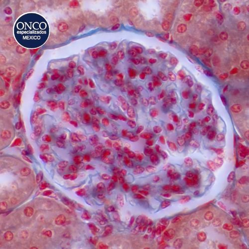 Microfotografía mostrando daño renal causado por lupus.