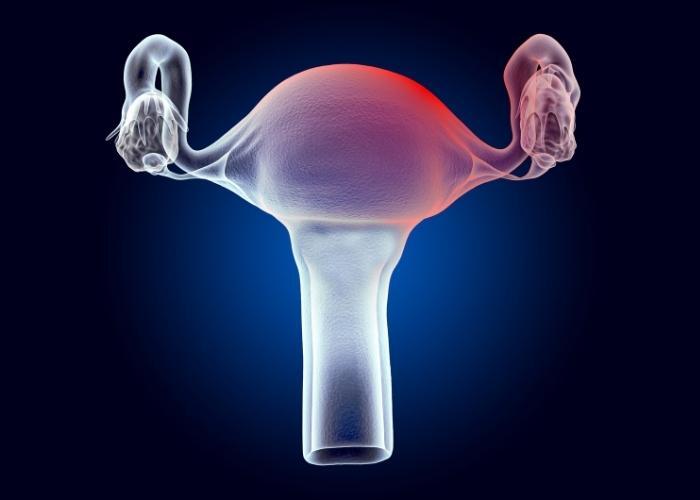 leuprorelina y mioma uterino