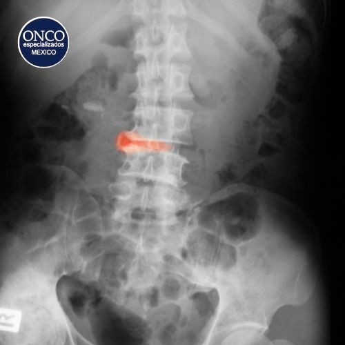 Radiografía usada para diagnóstico de espondilitis.