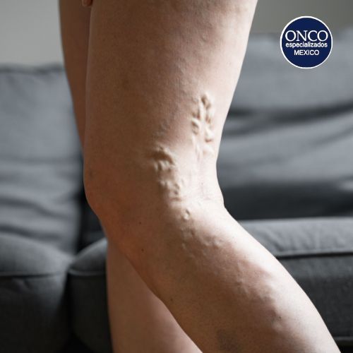 Pierna con venas prominentes, riesgo de trombosis asociado.