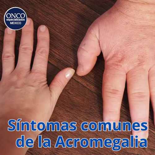 Manos y pies mostrando síntomas de la acromegalia.