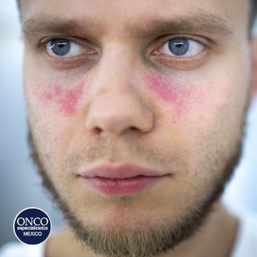 Hombre con eritema malar, síntoma característico del lupus.