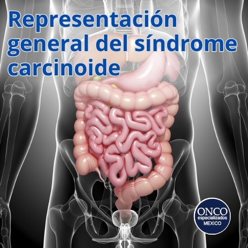 Una radiografía del estómago de una persona con las palabras general del síndrome carcinoide