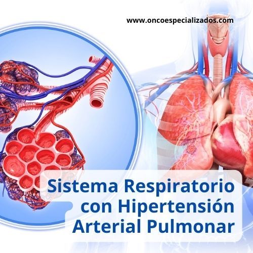 Ilustración del sistema respiratorio mostrando los efectos de la hipertensión arterial pulmonar.