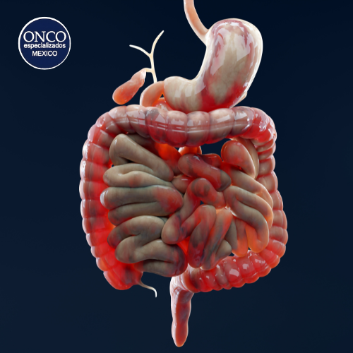 Inflamación intestinal en enfermedad de Crohn.