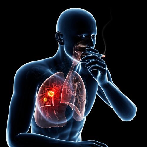 sprycel tratamiento cancer de pulmon