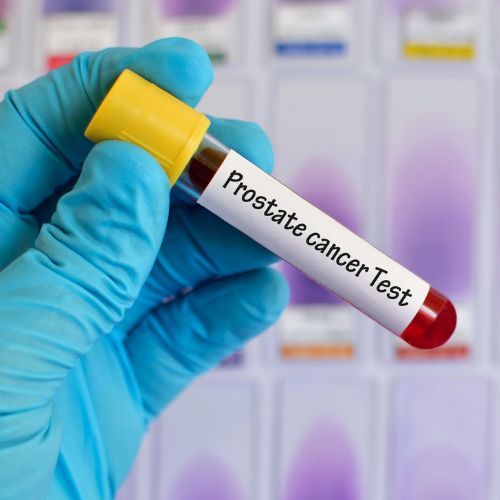 Una persona sostiene un tubo de ensayo que dice prueba de cáncer de próstata.