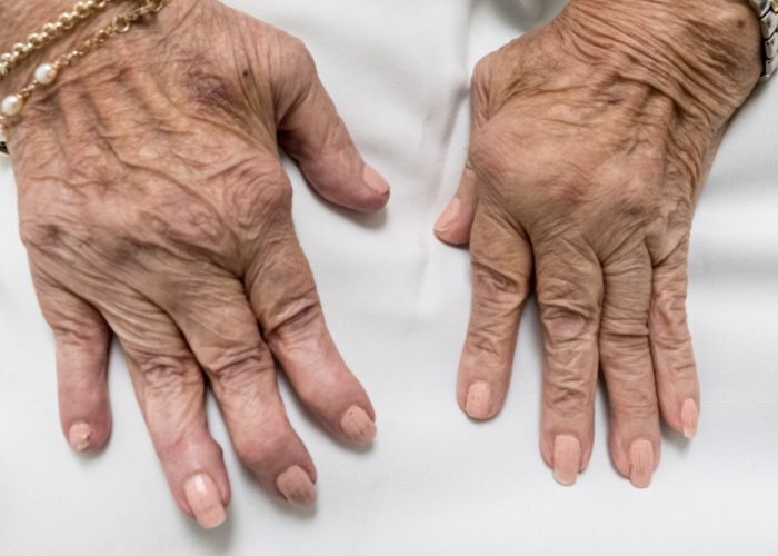 artritis reumatoide 2023