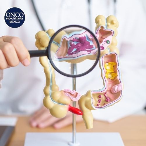 Diagrama ilustrativo explicando el cáncer colorrectal.