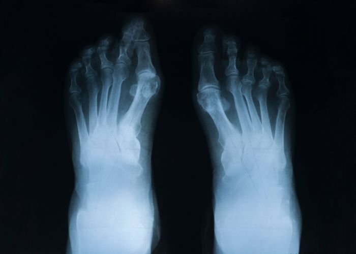 artritis reumatoide 2023 rayos x