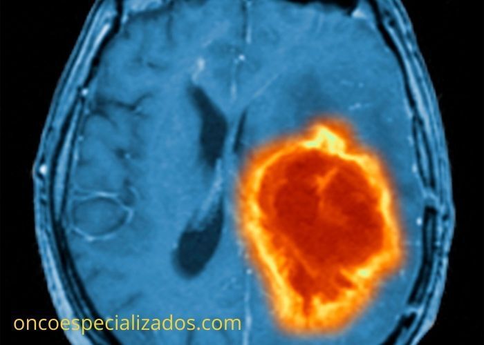 temozolomida tratamiento tumor cerebral