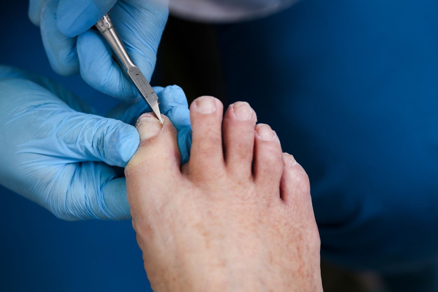 Physiotherapy essex - Laser physiotherapy on a patient in Wickford Physiotherpists Essex