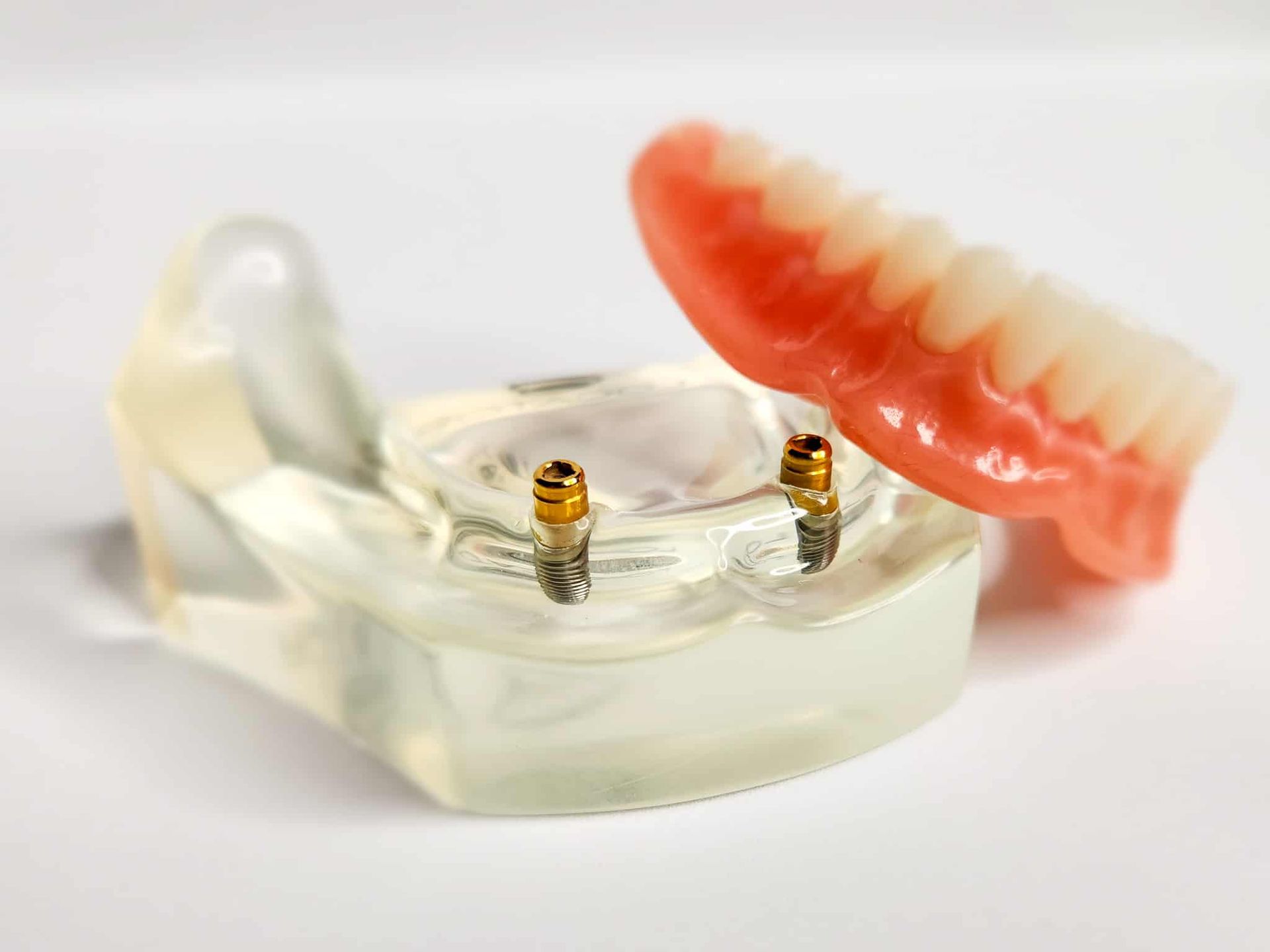 Model of a Denture With Two Dental Implants Attached to It — Cosmetic Denture Services–Jacob Maxwell in Mackay, QLD