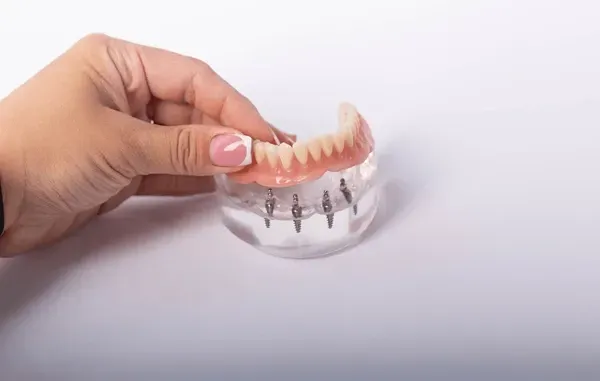 Person is Holding a Model of a Denture With Dental Implants — Cosmetic Denture Services–Jacob Maxwell in Mackay, QLD