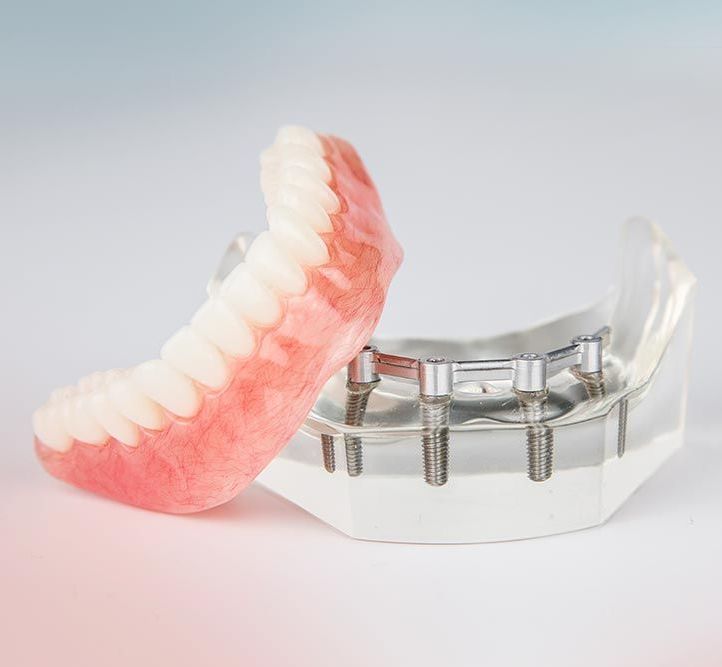 A Denture Is Sitting Next To A Model Of Dental Implants — Cosmetic Denture Services–Jacob Maxwell in Proserpine, QLD