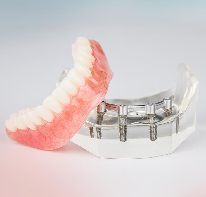 A Denture Is Sitting Next To A Model Of A Dental Implant — Cosmetic Denture Services–Jacob Maxwell in Mackay, QLD