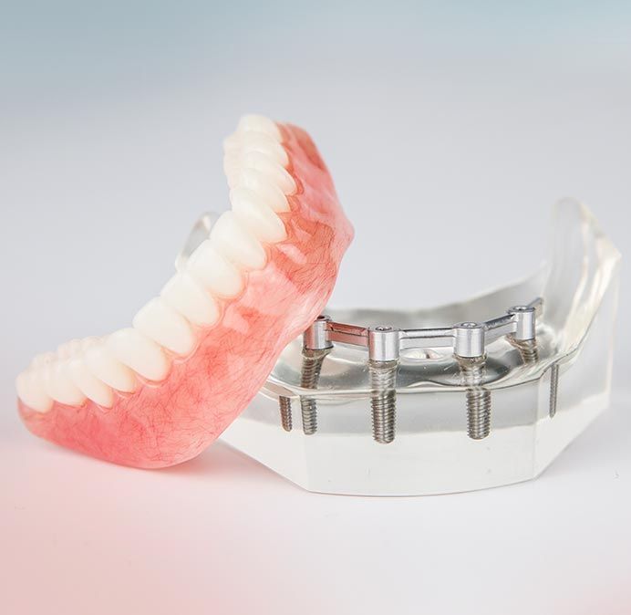 Denture is Sitting Next to a Model of Dental Implants — Cosmetic Denture Services–Jacob Maxwell in Moranbah, QLD