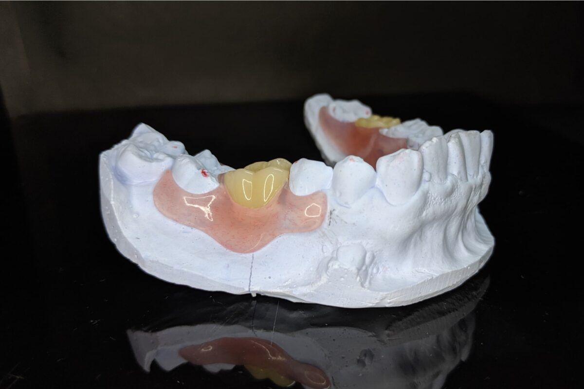 A Model Of A Person 's Teeth With A Denture On A Black Surface — Cosmetic Denture Services–Jacob Maxwell in Mackay, QLD