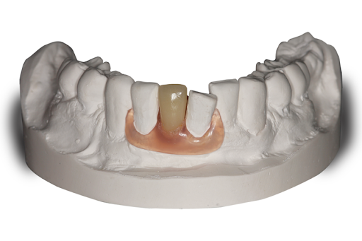 Model of a Person 's Teeth With a Tooth Missing — Cosmetic Denture Services–Jacob Maxwell in Sarina, QLD