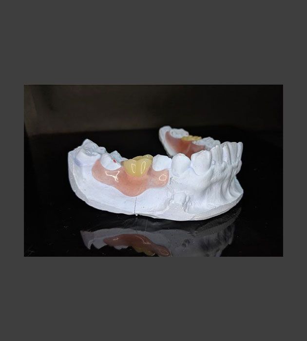 A Model Of A Person 's Teeth Is Sitting On A Table — Cosmetic Denture Services–Jacob Maxwell in Mackay, QLD