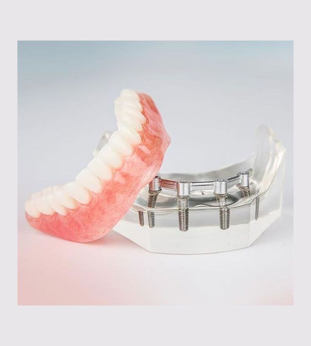 Model of a Denture and Dental Implants on a Table — Cosmetic Denture Services–Jacob Maxwell in Mackay, QLD